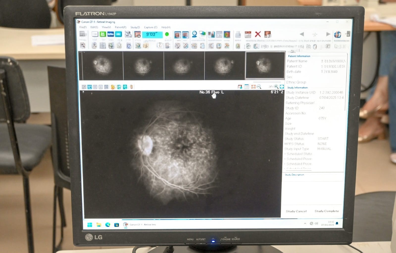 Glaucoma evolui sem sintomas e já é a principal causa de cegueira irreversível no mundo